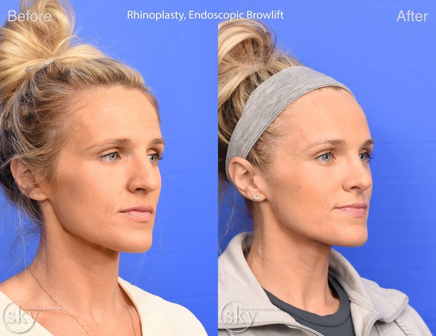 Brow Lift Before & After