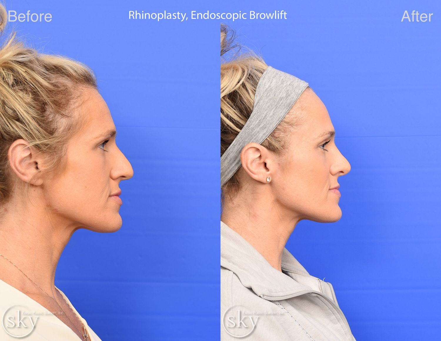 Brow Lift Before & After