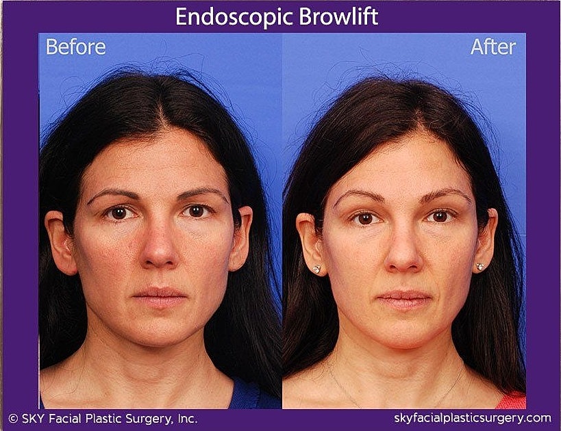 Brow Lift Before & After