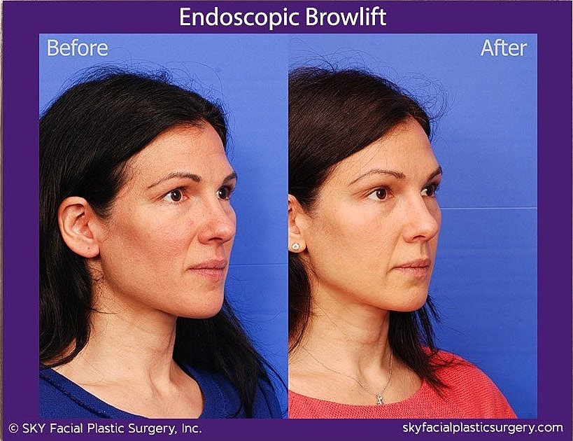 Brow Lift Before & After