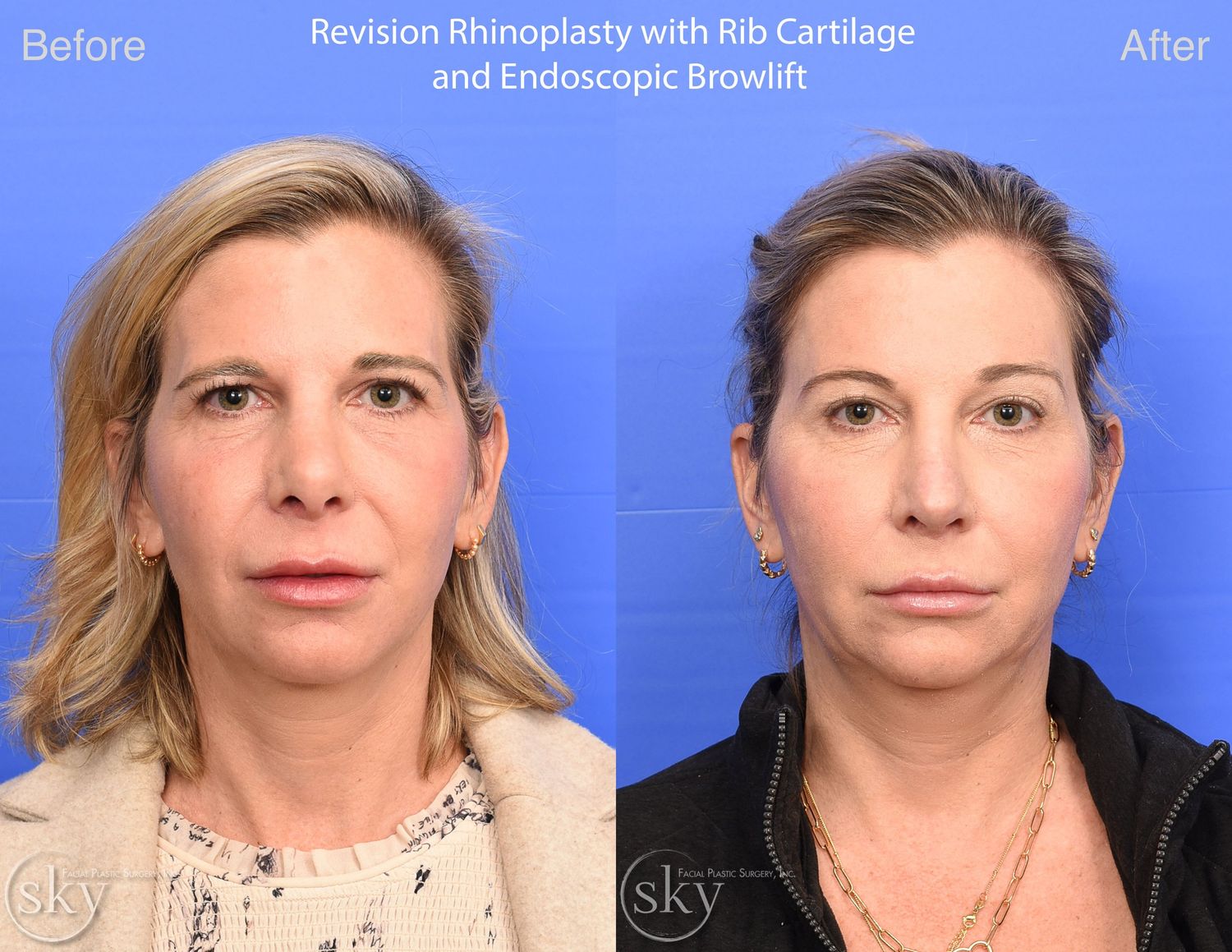 Brow Lift Before & After