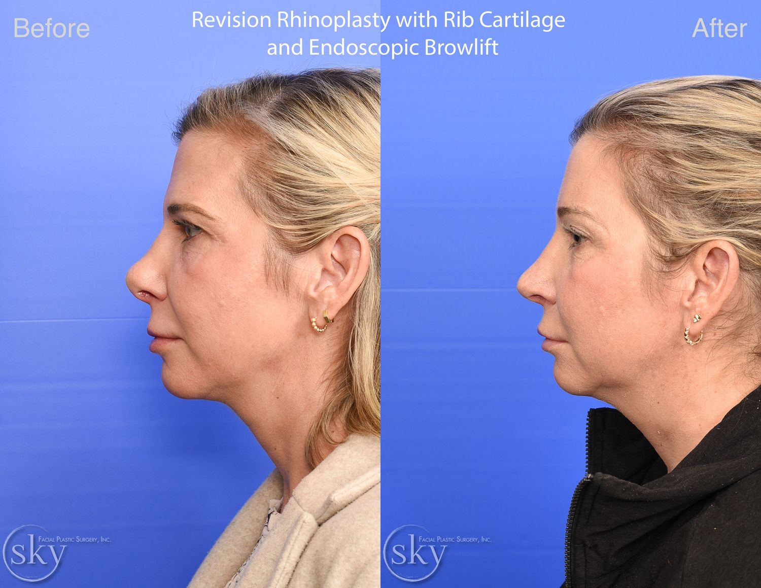 Brow Lift Before & After