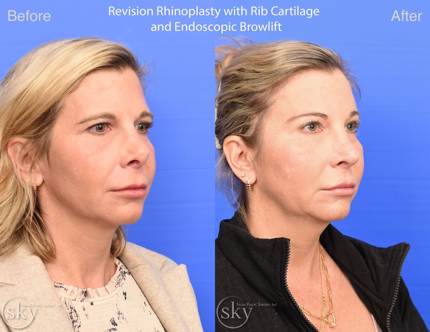 Brow Lift Before & After