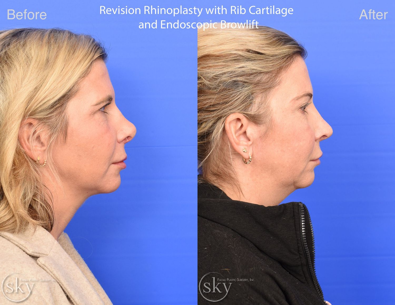 Brow Lift Before & After