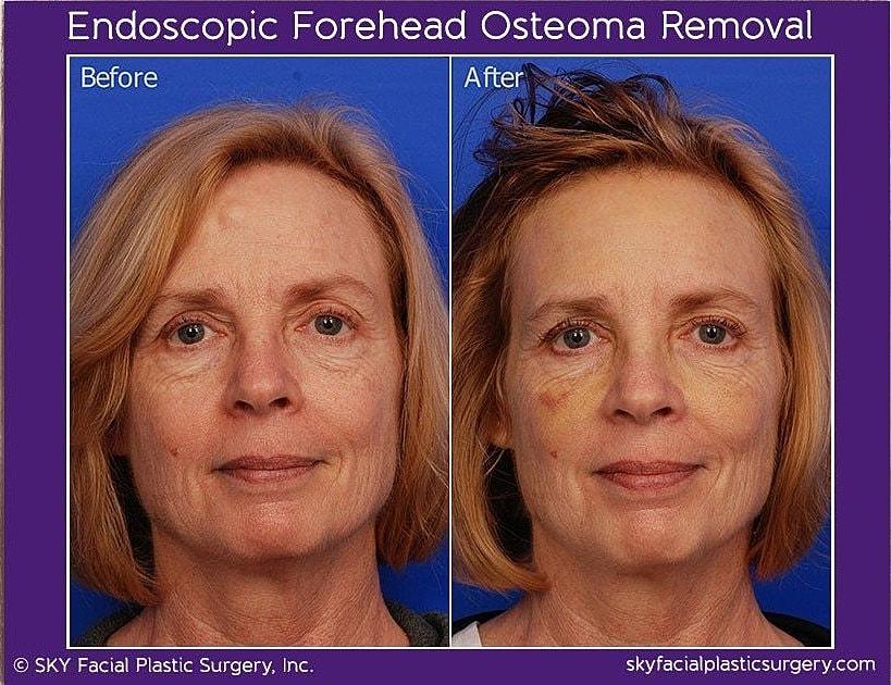 Endoscopic Forehead Osteoma Removal Before & After