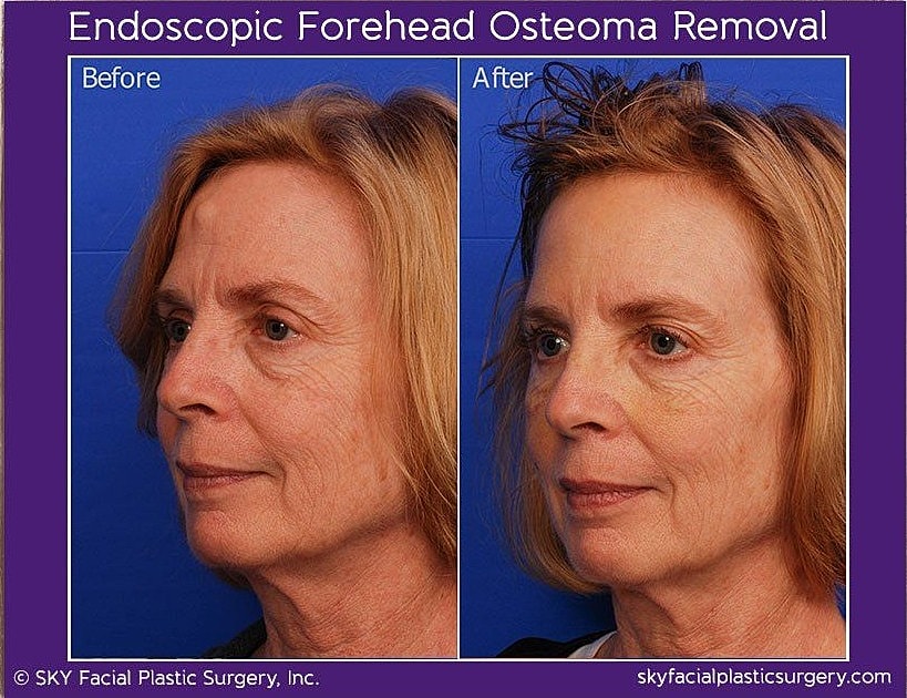Endoscopic Forehead Osteoma Removal Before & After