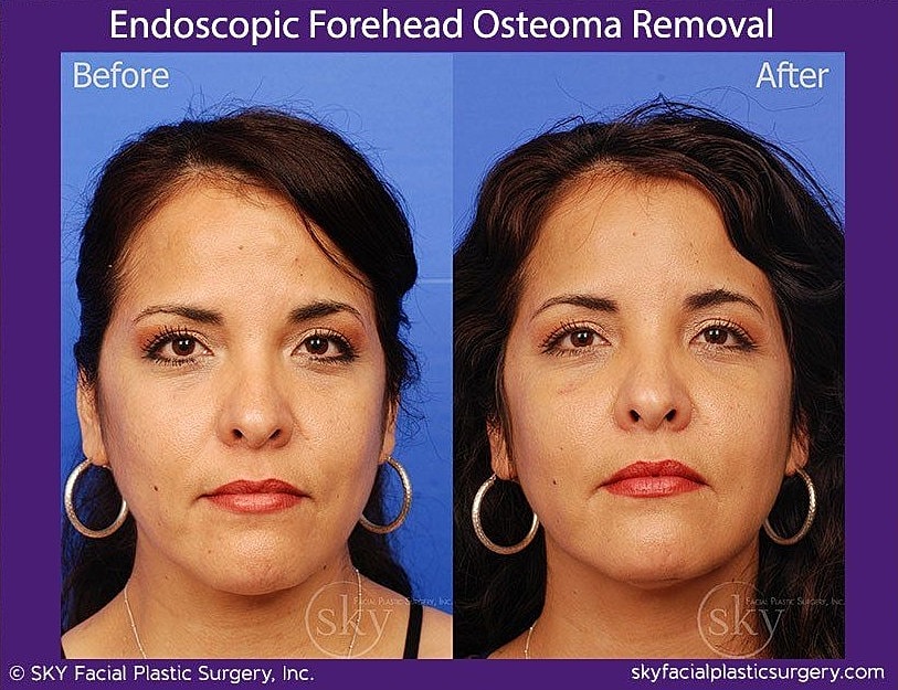 Endoscopic Forehead Osteoma Removal Before & After