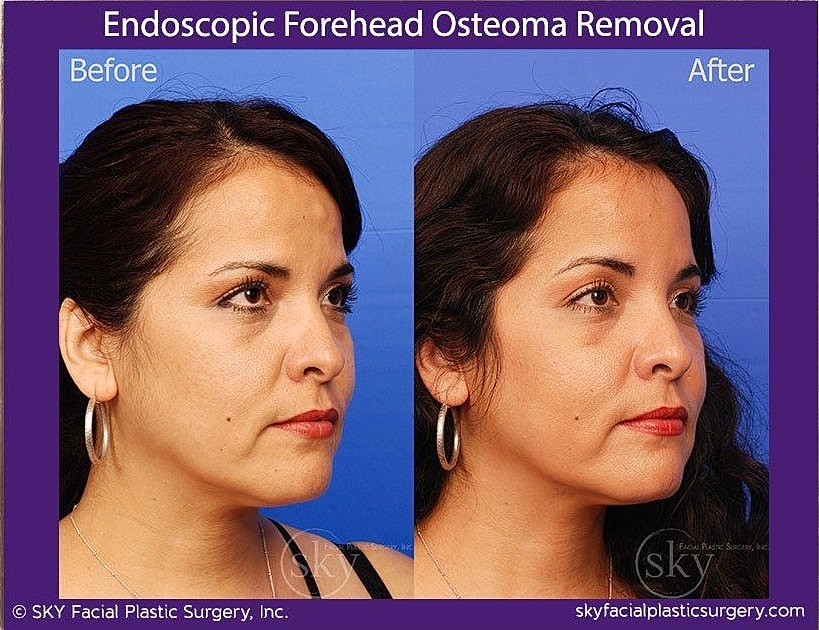 Endoscopic Forehead Osteoma Removal Before & After