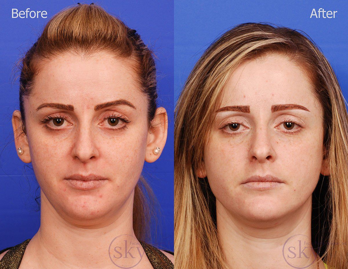 Pearl Fractional Before & After