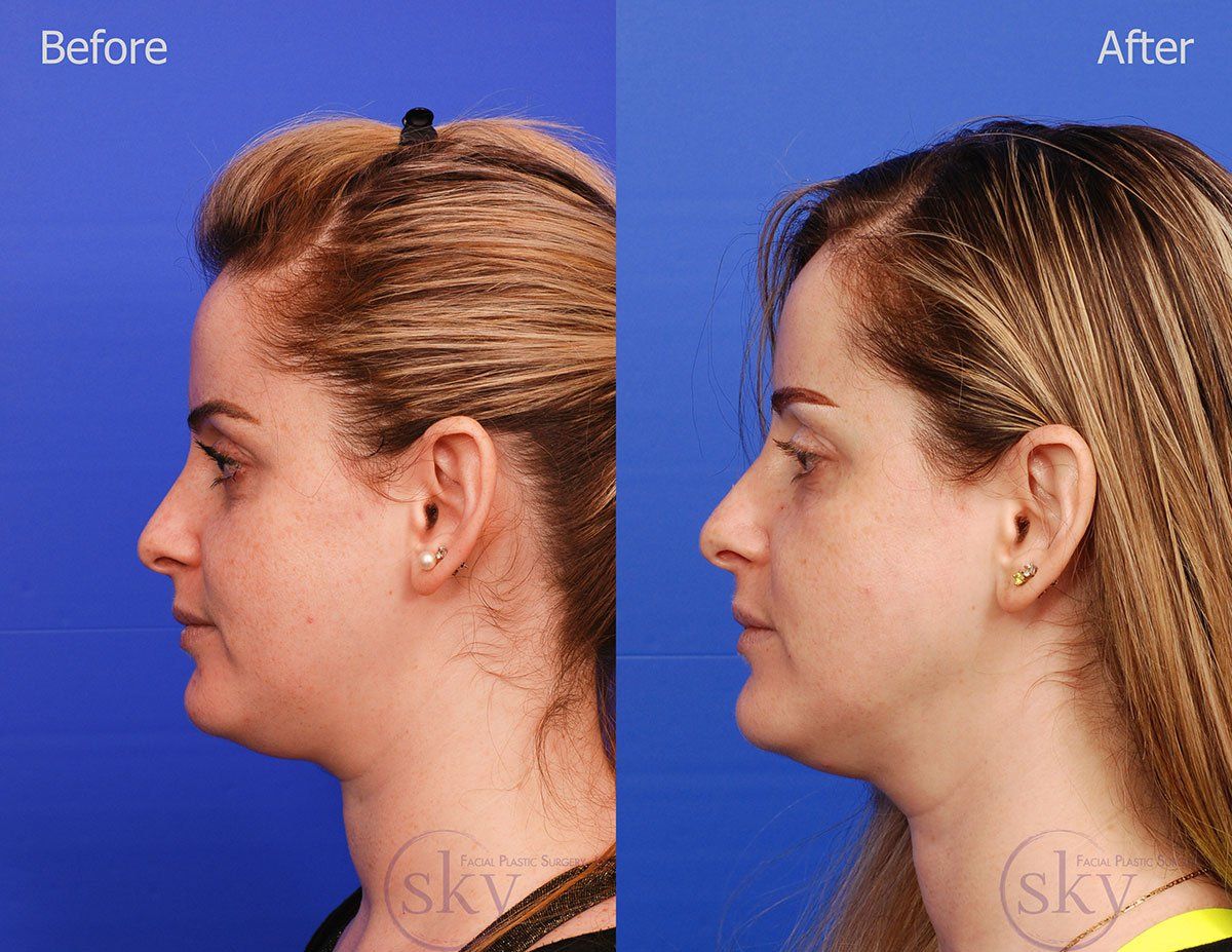 Pearl Fractional Before & After