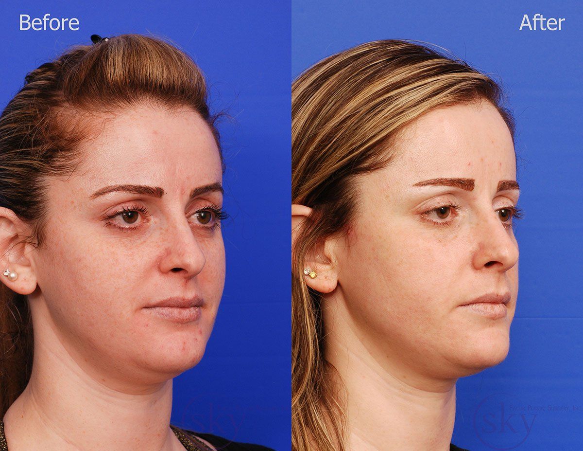 Pearl Fractional Before & After