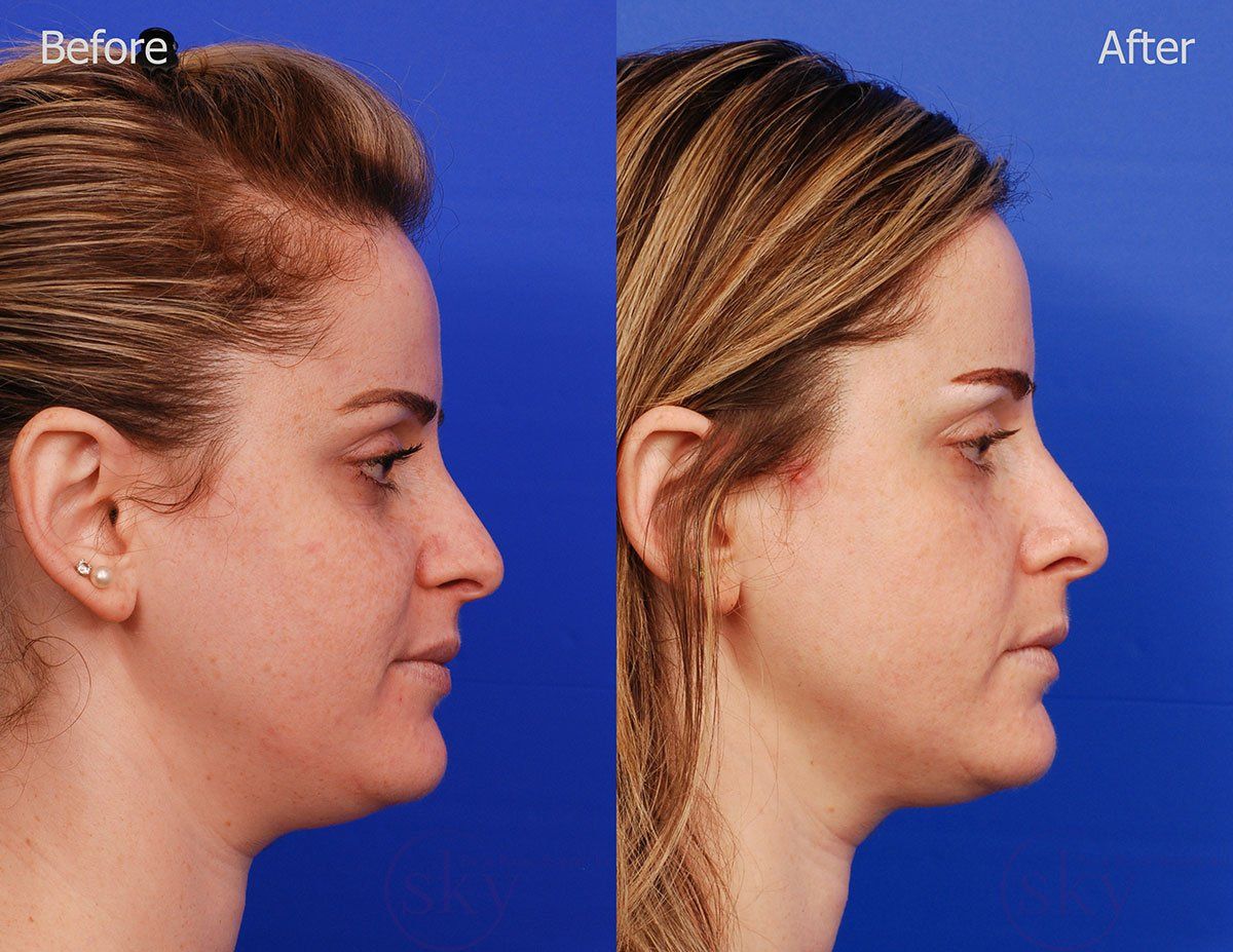 Pearl Fractional Before & After