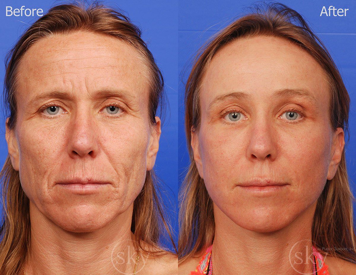 Pearl Fractional Before & After