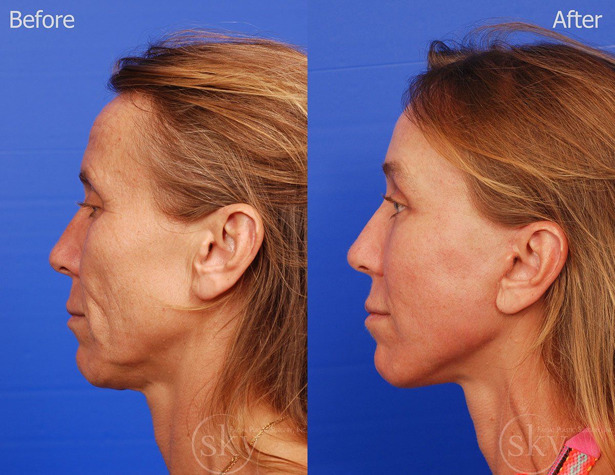 Pearl Fractional Before & After