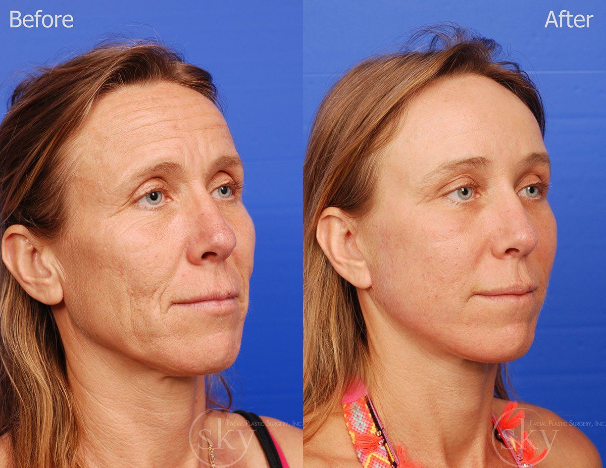 Pearl Fractional Before & After
