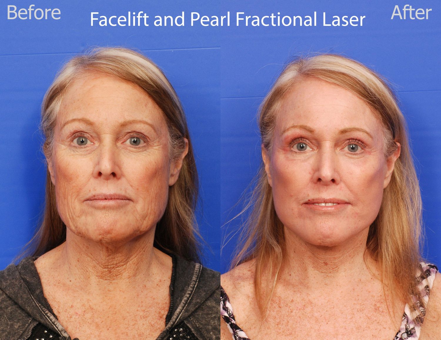 Pearl Fractional Before & After