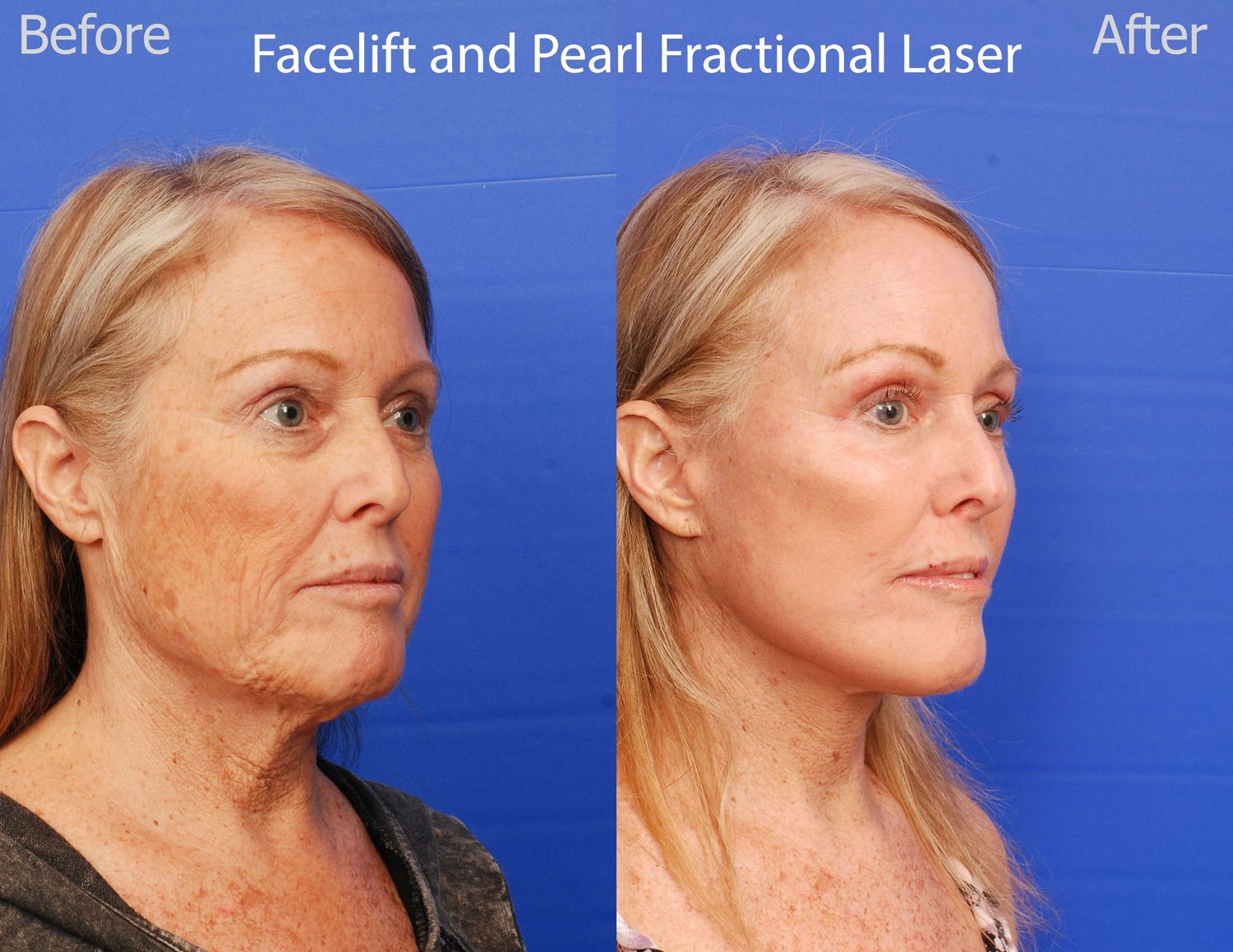 Pearl Fractional Before & After