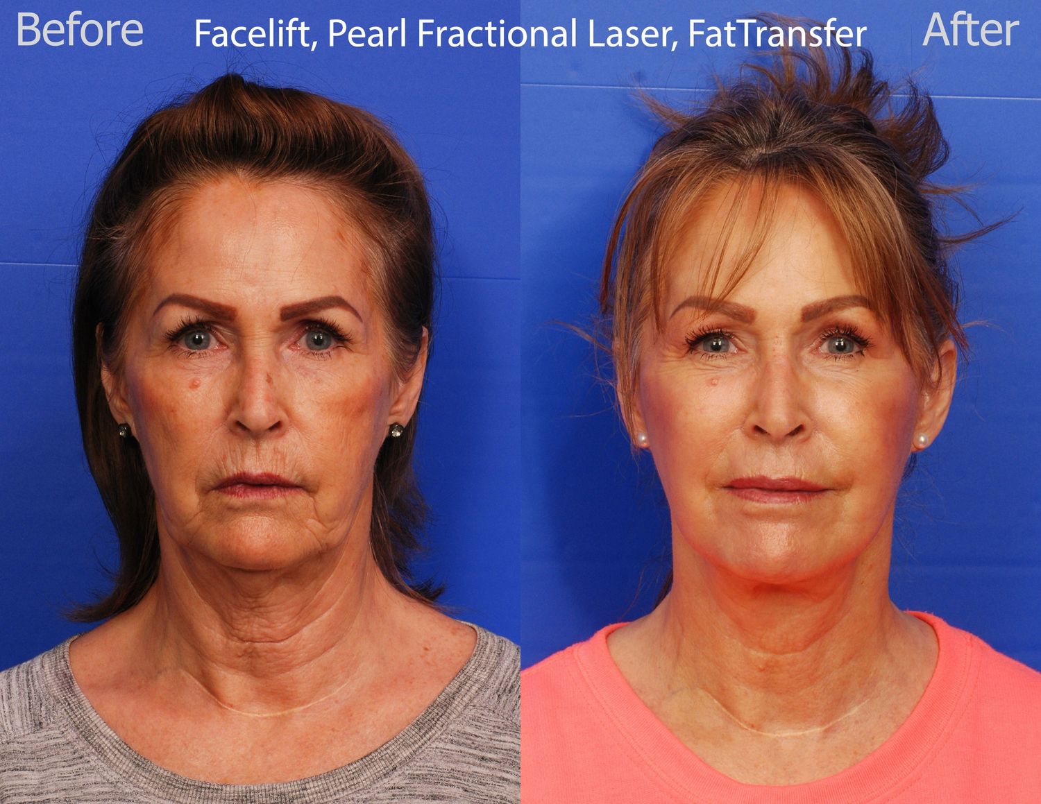Pearl Fractional Before & After