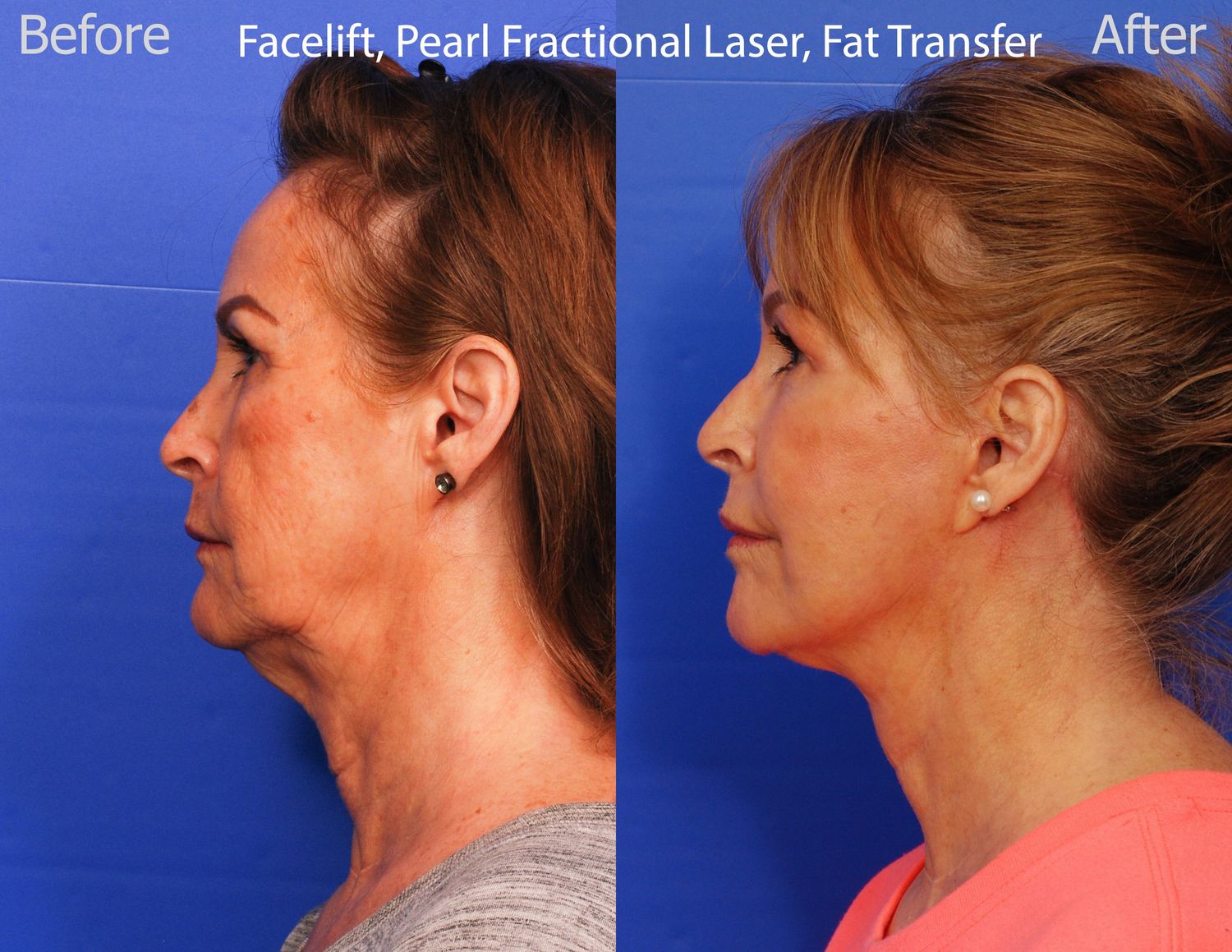 Pearl Fractional Before & After