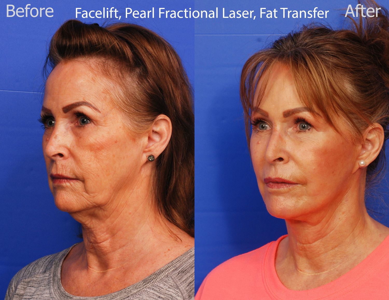 Pearl Fractional Before & After