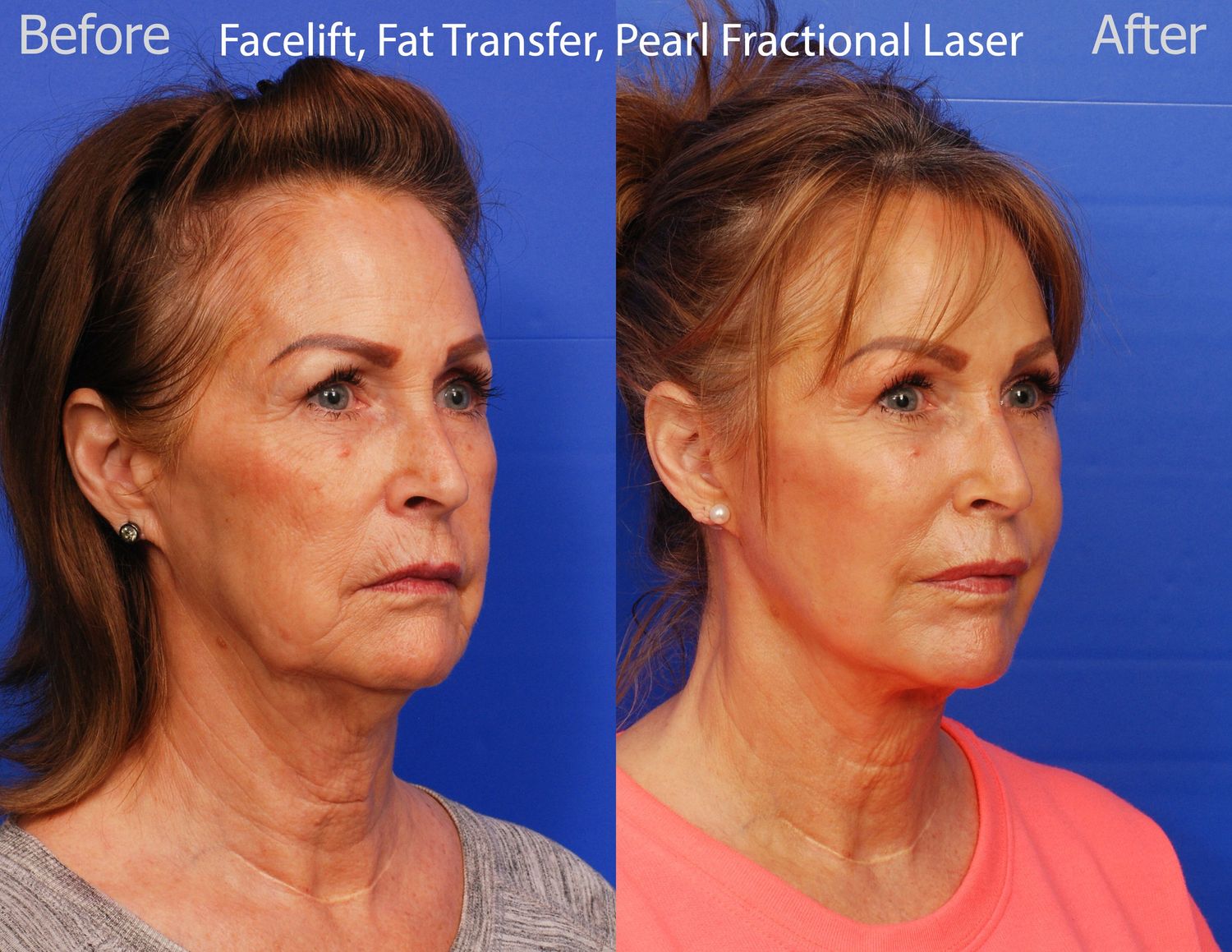 Pearl Fractional Before & After