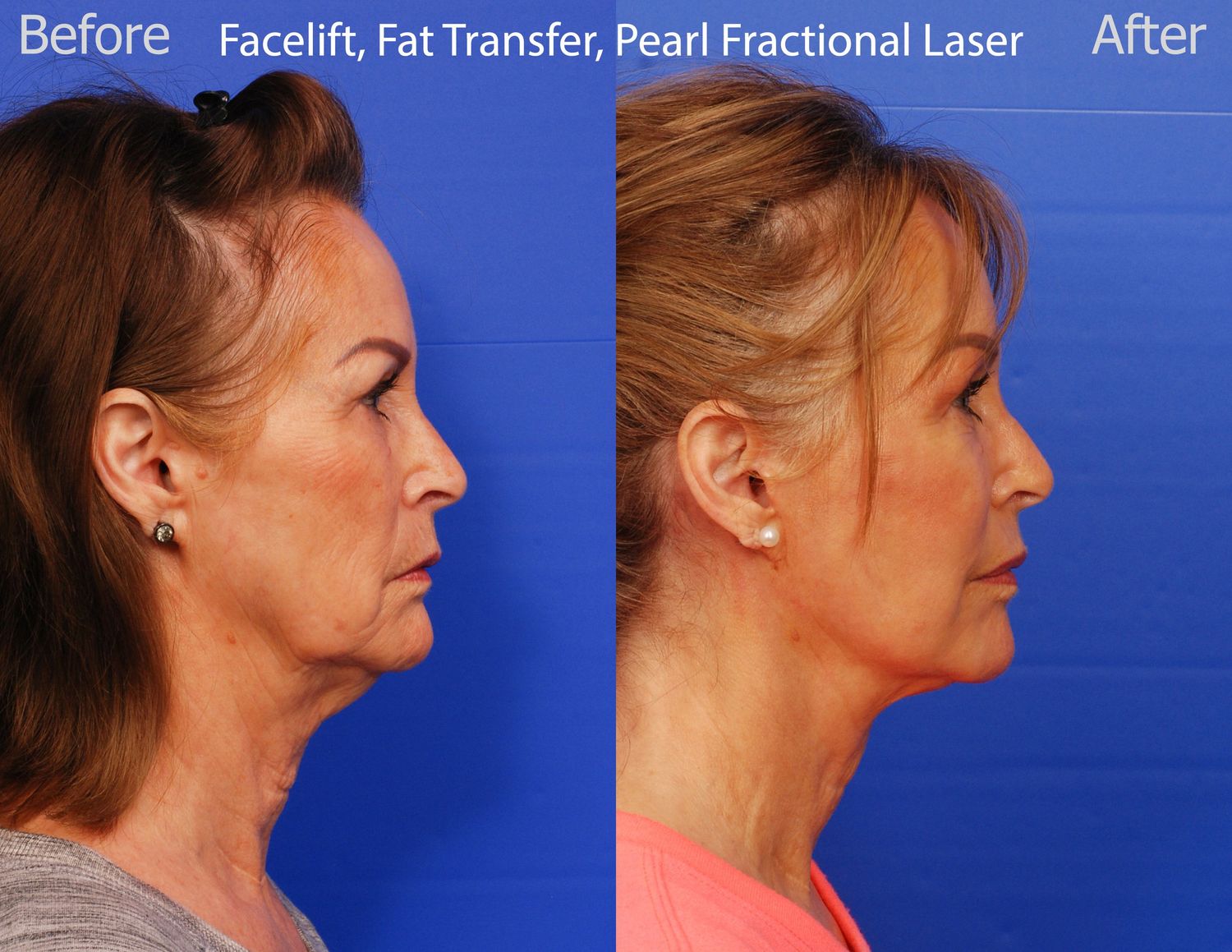 Pearl Fractional Before & After