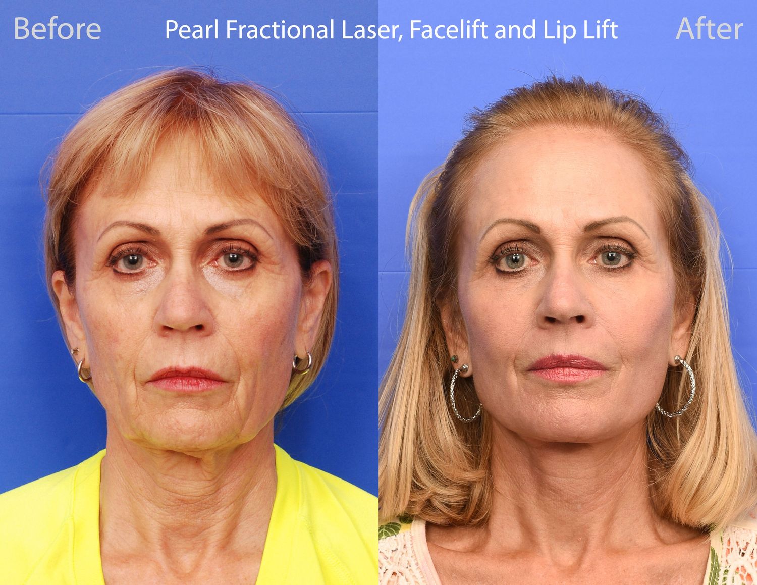 Pearl Fractional Before & After