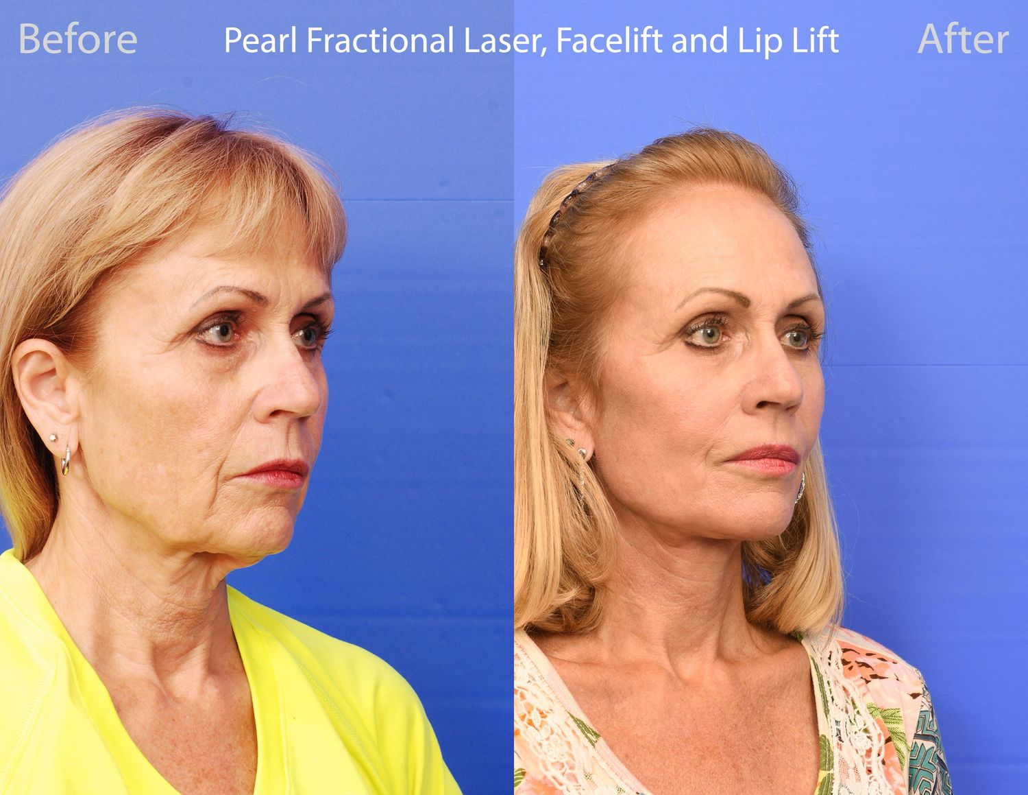 Pearl Fractional Before & After