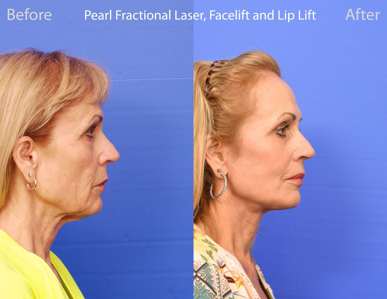 Pearl Fractional Before & After