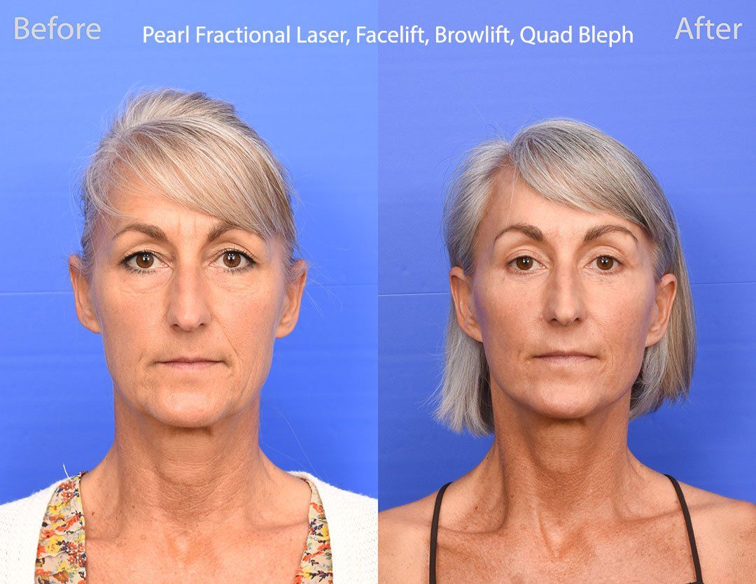 Pearl Fractional Before & After