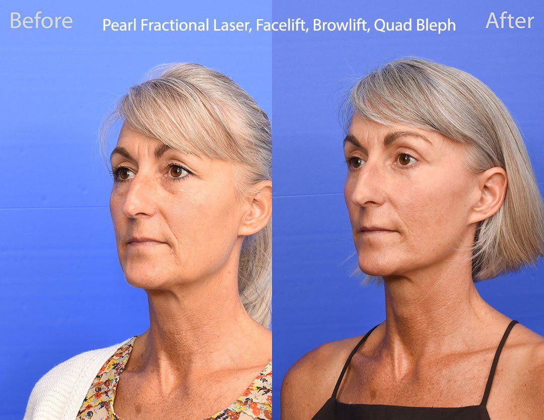 Pearl Fractional Before & After