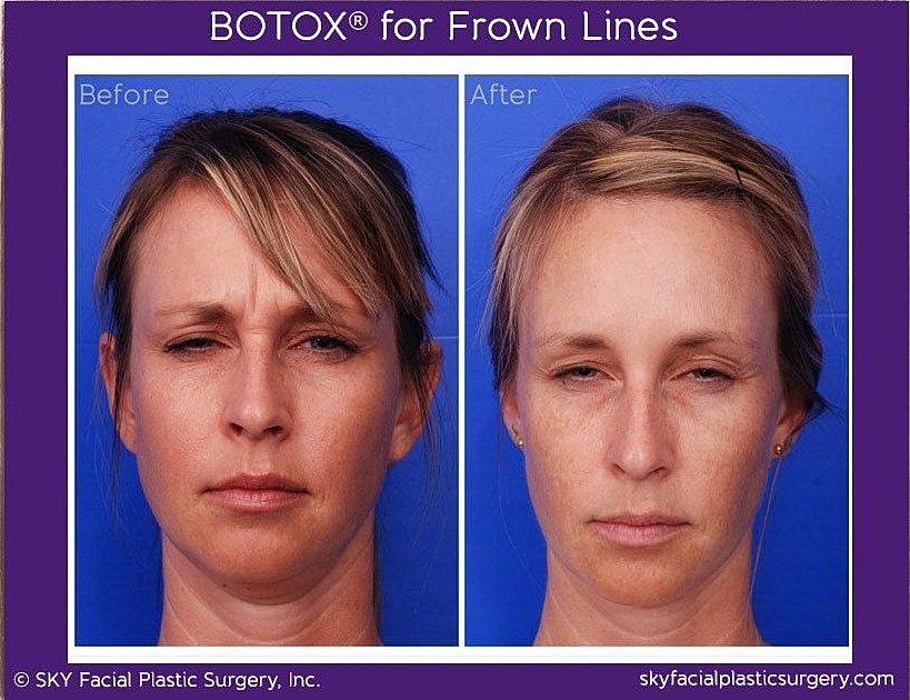 Botox To Frown Lines Before & After