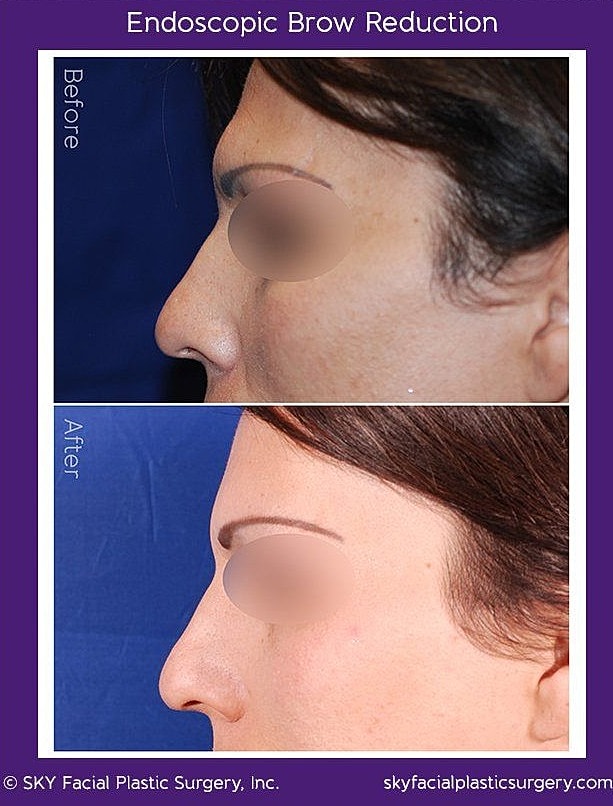 Endoscopic Brow Reduction Before & After