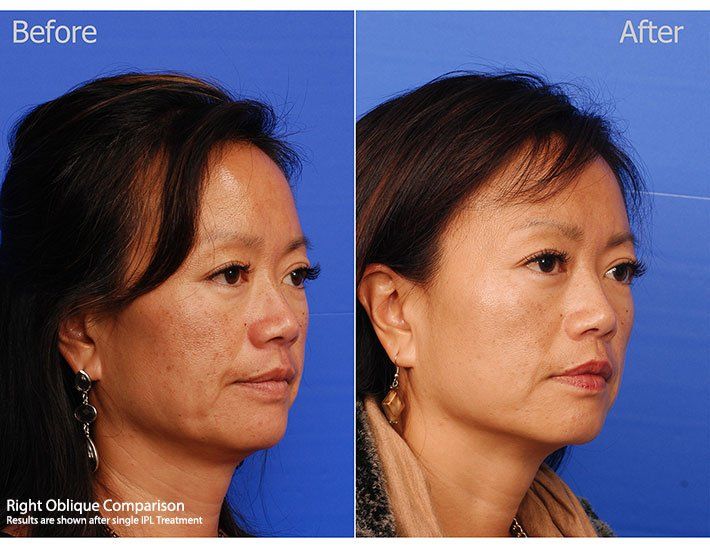 Ipl Laser Before & After