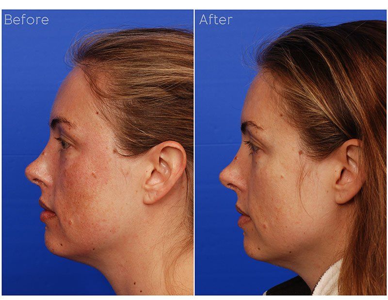 Ipl Laser Before & After