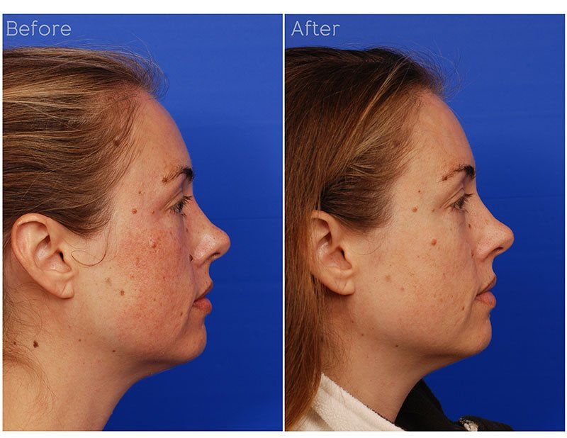 Ipl Laser Before & After