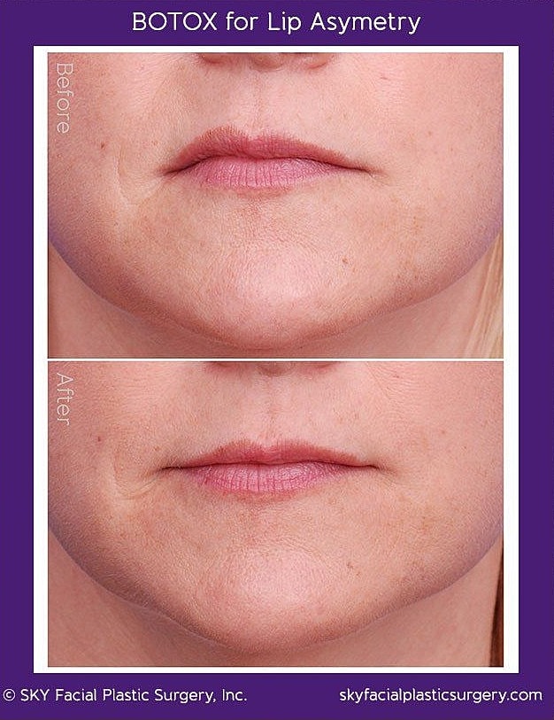 Botox Lip Asymmetry Before & After