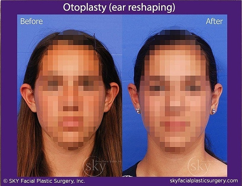 Otoplasty Before & After