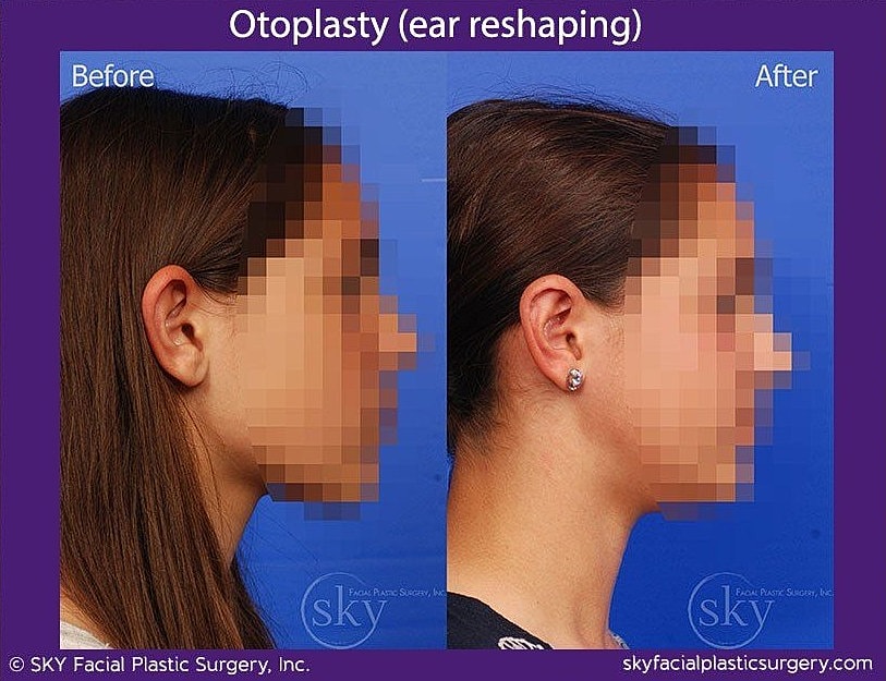 Otoplasty Before & After