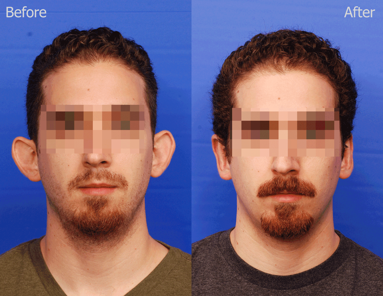 Otoplasty Before & After