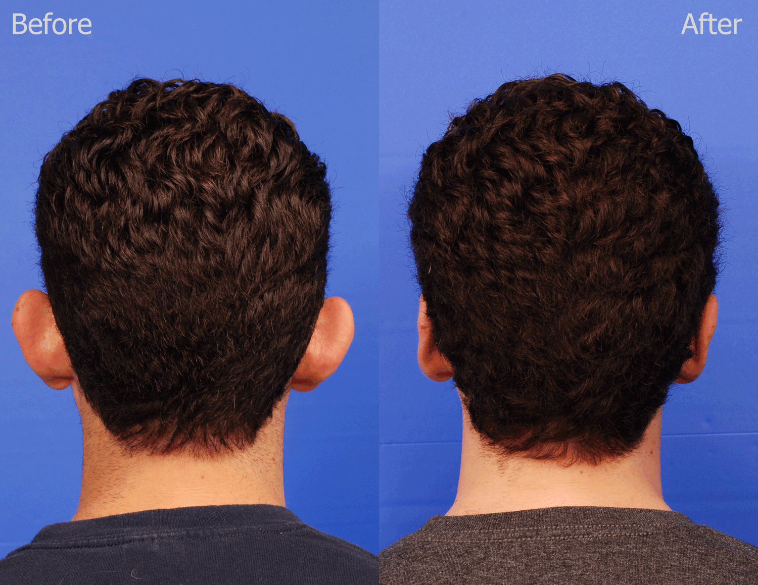 Otoplasty Before & After