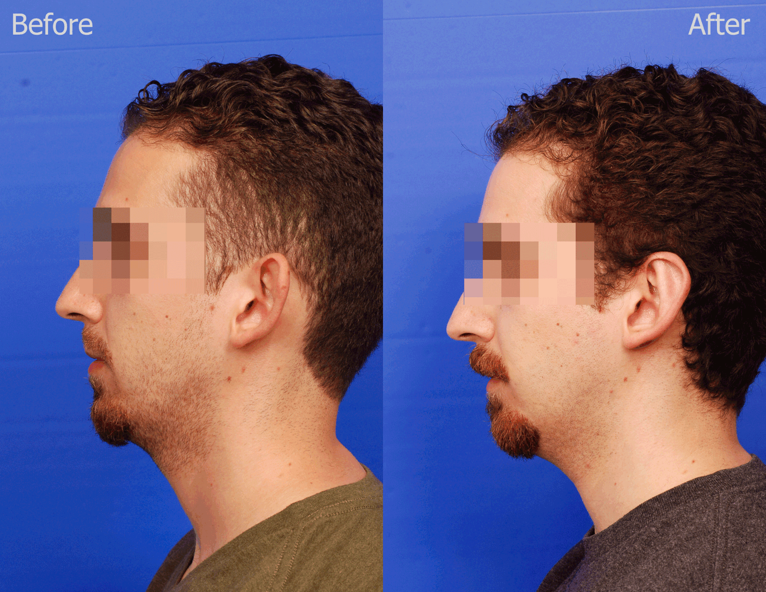 Otoplasty Before & After