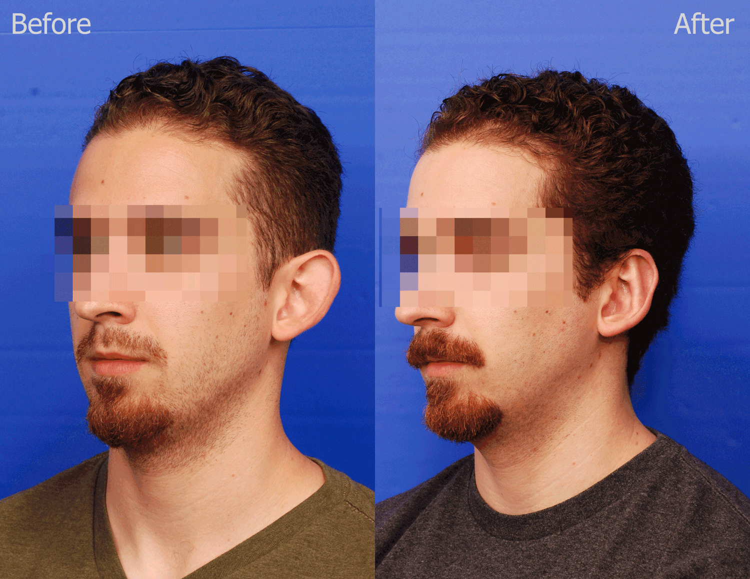 Otoplasty Before & After