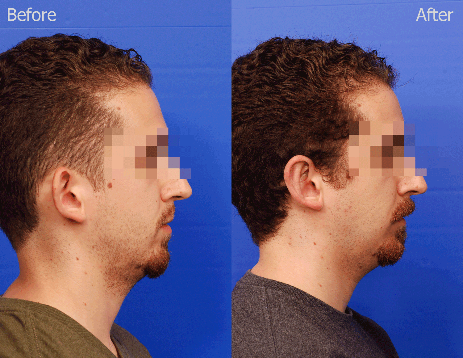 Otoplasty Before & After