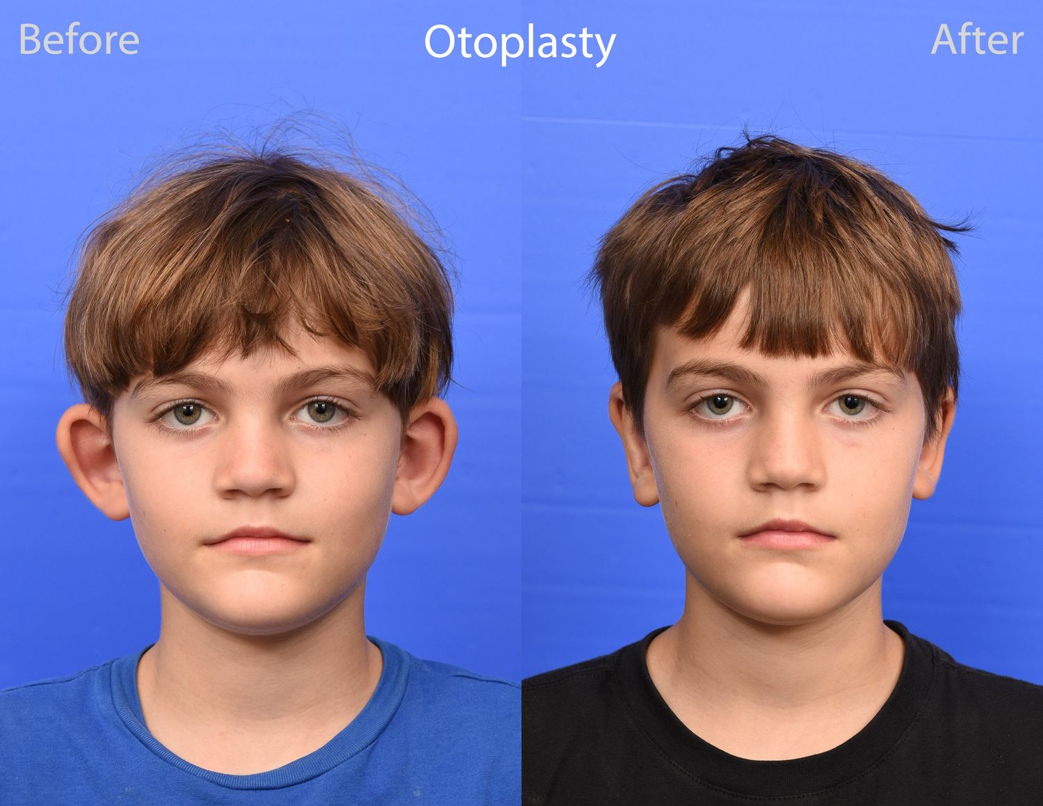 Otoplasty Before & After