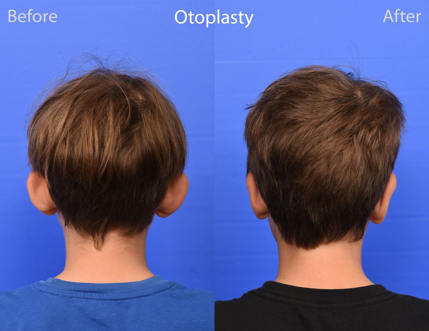 Otoplasty Before & After