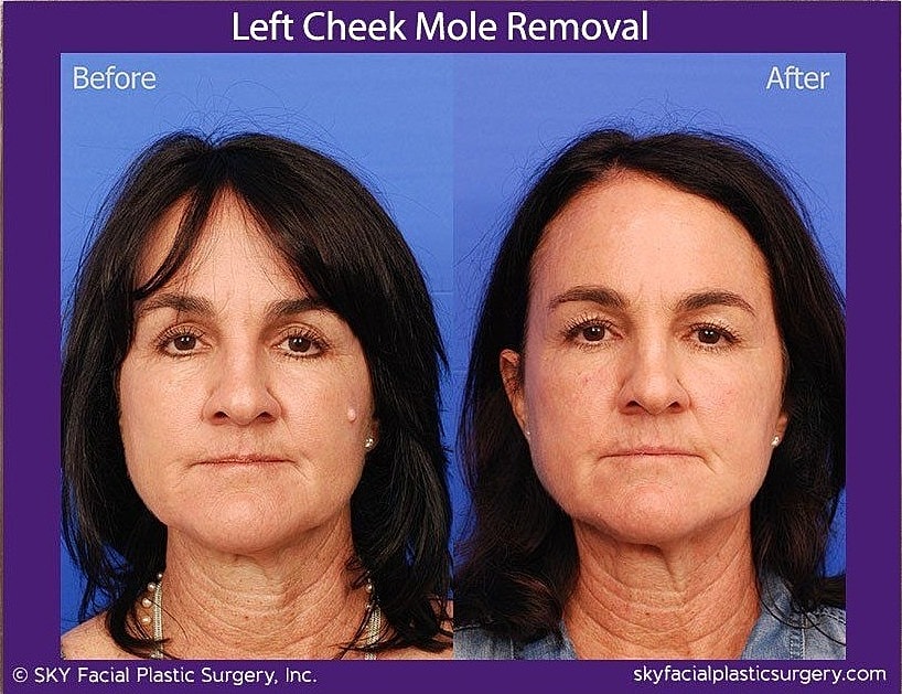 Mole Removal Before & After