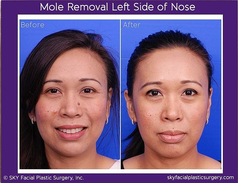Mole Removal Before & After