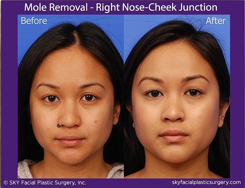 Mole Removal Before & After