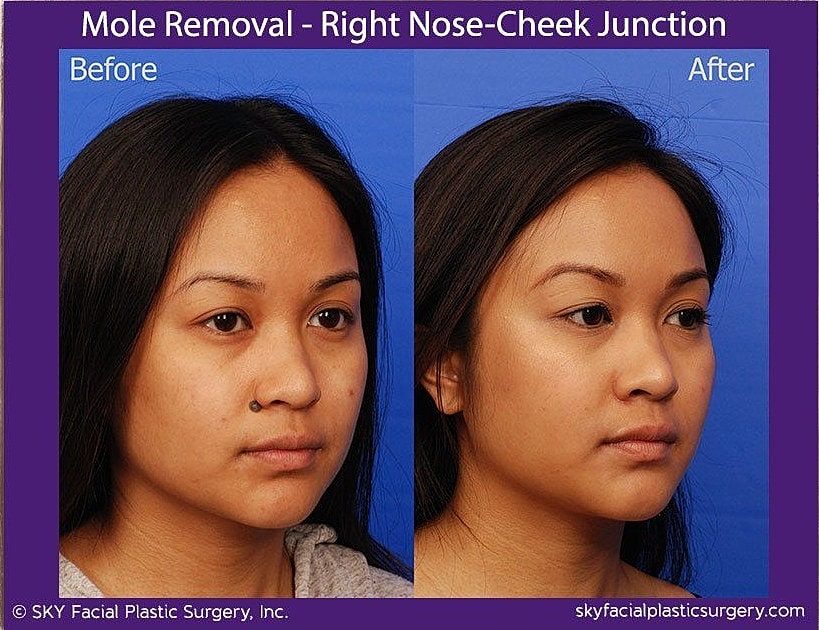 Mole Removal Before & After